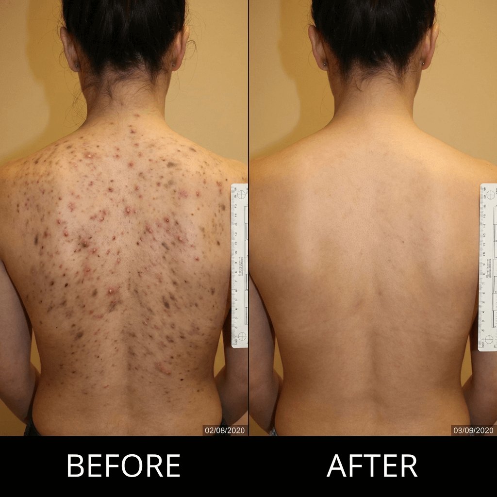 Back Acne Removal Bar