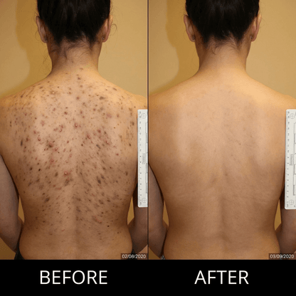 Back Acne Removal Bar
