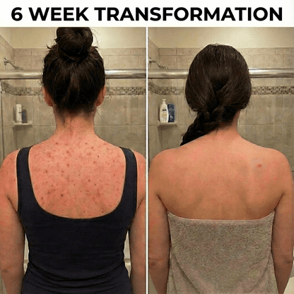 Back Acne Removal Bar