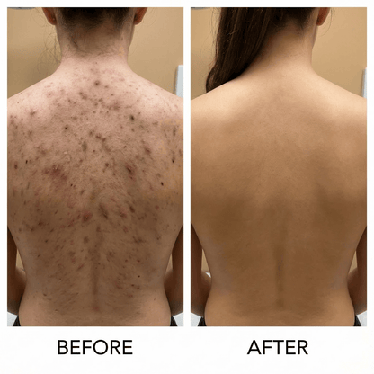 Back Acne Removal Bar