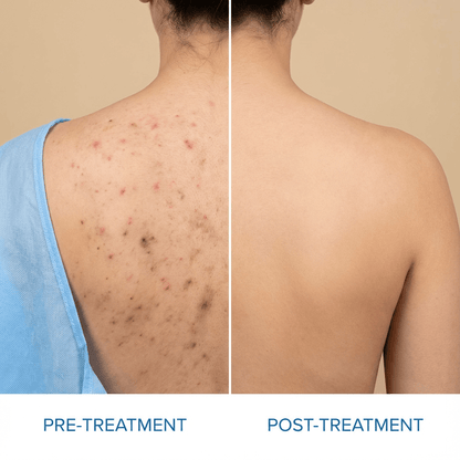 Back Acne Removal Bar